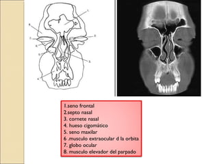 1.seno frontal 
2.septo nasal 
3. cornete nasal 
4. hueso cigomático 
5. seno maxilar 
6 .musculo extraocular d la orbita 
7. globo ocular 
8. musculo elevador del parpado 
 