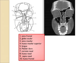 1. seno frontal 
2. globo ocular 
3. seno maxilar 
4. hueso maxilar superior 
5. lengua 
6. Paladar duro 
7. cornete nasal 
8. hueso nasal 
9. septo nasal 
10. hueso frontal 
 