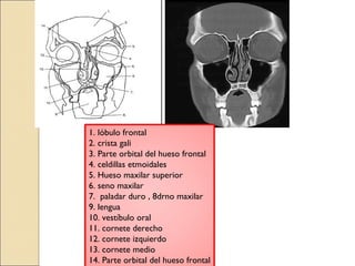 1. lóbulo frontal 
2. crista gali 
3. Parte orbital del hueso frontal 
4. celdillas etmoidales 
5. Hueso maxilar superior 
6. seno maxilar 
7. paladar duro , 8drno maxilar 
9. lengua 
10. vestíbulo oral 
11. cornete derecho 
12. cornete izquierdo 
13. cornete medio 
14. Parte orbital del hueso frontal 
 