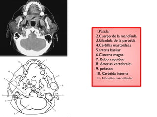 1.Paladar 
2.Cuerpo de la mandíbula 
3.Glandula de la parótida 
4.Celdillas mastoideas 
5.arteria basilar 
6.Cisterna magna 
7. Bulbo raquídeo 
8. Arterias vertebrales 
9. peñasco 
10. Carótida interna 
11. Cóndilo mandibular 
 