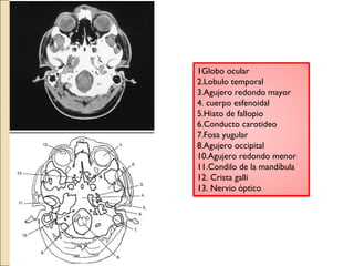 1Globo ocular 
2.Lobulo temporal 
3.Agujero redondo mayor 
4. cuerpo esfenoidal 
5.Hiato de fallopio 
6.Conducto carotideo 
7.Fosa yugular 
8.Agujero occipital 
10.Agujero redondo menor 
11.Condilo de la mandíbula 
12. Crista galli 
13. Nervio óptico 
 