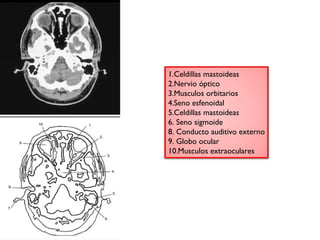 1.Celdillas mastoideas 
2.Nervio óptico 
3.Musculos orbitarios 
4.Seno esfenoidal 
5.Celdillas mastoideas 
6. Seno sigmoide 
8. Conducto auditivo externo 
9. Globo ocular 
10.Musculos extraoculares 
 