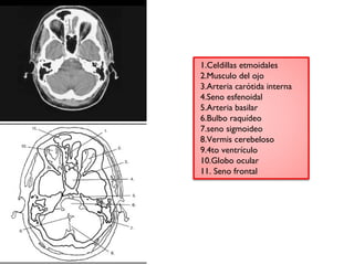 1.Celdillas etmoidales 
2.Musculo del ojo 
3.Arteria carótida interna 
4.Seno esfenoidal 
5.Arteria basilar 
6.Bulbo raquídeo 
7.seno sigmoideo 
8.Vermis cerebeloso 
9.4to ventrículo 
10.Globo ocular 
11. Seno frontal 
 