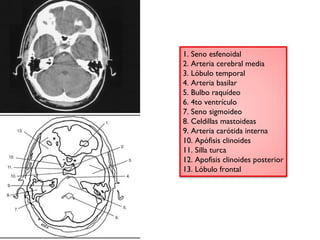 1. Seno esfenoidal 
2. Arteria cerebral media 
3. Lóbulo temporal 
4. Arteria basilar 
5. Bulbo raquídeo 
6. 4to ventrículo 
7. Seno sigmoideo 
8. Celdillas mastoideas 
9. Arteria carótida interna 
10. Apófisis clinoides 
11. Silla turca 
12. Apofisis clinoides posterior 
13. Lóbulo frontal 
 