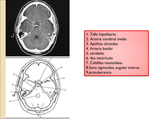 1. Tallo hipofisario 
2. Arteria cerebral media 
3. Apófisis clinoides 
4. Arteria basilar 
5. cerebelo 
6. 4to ventrículo 
7. Celdillas mastoideas 
8.Seno sigmoideo yugular interna 
9.protuberancia 
 