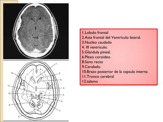 1.Lobulo frontal 
2.Asta frontal del Ventrículo lateral. 
3.Nucleo caudado 
4. III ventrículo. 
5.Glandula pineal. 
6.Plexo coroideo. 
8.Seno recto 
9.Cerebelo 
10.Brazo posterior de la capsula interna 
11.Tronco cerebral 
12.talamo 
 