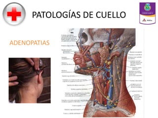 PATOLOGÍAS DE CUELLO
ADENOPATIAS
 