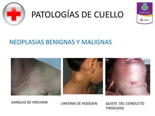PATOLOGÍAS DE CUELLO
NEOPLASIAS BENIGNAS Y MALIGNAS
GANGLIO DE VIRCHOW LINFOMA DE HODGKIN QUISTE DEL CONDUCTO
TIROGLOSO
 