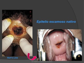 Hart’s Line
Epitelio escamoso nativo
DR ROBERTO RODRIGUEZ FAJARDO
 