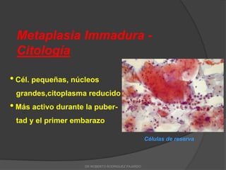 Metaplasia Immadura -
Citología
• Cél. pequeñas, núcleos
grandes,citoplasma reducido
• Más activo durante la puber-
tad y el primer embarazo
Células de reserva
DR ROBERTO RODRIGUEZ FAJARDO
 