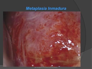 Metaplasia Inmadura
DR ROBERTO RODRIGUEZ FAJARDO
 