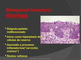 Metaplasia Inmadura-
Histología
• Delgada,epitelio
indiferenciado
• Inicia como hiperplasia de
células de reserva
• Asociado a procesos
inflamatorios(“cervicitis
crónica”)
• Restos vellosos
DR ROBERTO RODRIGUEZ FAJARDO
 