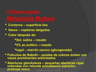 Colposcopía-
Metaplasia Madura
• Contorno – superficie lisa
• Vasos – capilares delgados
• Color después de:
•Sol. salina – rosado
•5% ac.acético – rosado
•lugol – marrón oscuro (glicogenado)
• Folículos de Naboth – quistes de colores ámbar con
vasos prominentes arborizados
• Aberturas glandulares – pequeñas aberturas rojas
redondas con reborde acetoblanco estrecho ,
protruye moco DR ROBERTO RODRIGUEZ FAJARDO
 