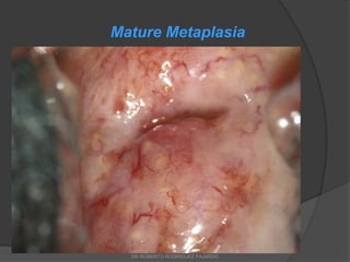 Mature Metaplasia
DR ROBERTO RODRIGUEZ FAJARDO
 