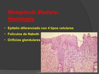 Metaplasia Madura-
Histología
• Epitelio diferenciado con 4 tipos celulares
• Folículos de Naboth
• Orificios glandulares
DR ROBERTO RODRIGUEZ FAJARDO
 