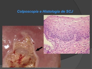 Colposcopía e Histología de SCJ
DR ROBERTO RODRIGUEZ FAJARDO
 