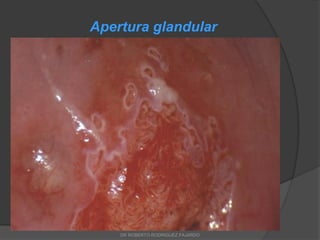 Apertura glandular
DR ROBERTO RODRIGUEZ FAJARDO
 