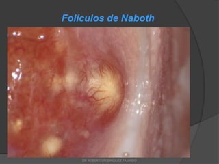 Folículos de Naboth
DR ROBERTO RODRIGUEZ FAJARDO
 