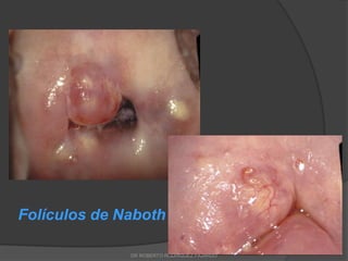 Folículos de Naboth
DR ROBERTO RODRIGUEZ FAJARDO
 