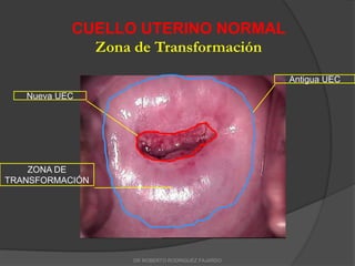 CUELLO UTERINO NORMAL
Zona de Transformación
Antigua UEC
Nueva UEC
ZONA DE
TRANSFORMACIÓN
DR ROBERTO RODRIGUEZ FAJARDO
 