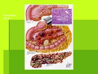 Pancrestitis
Aguda
 