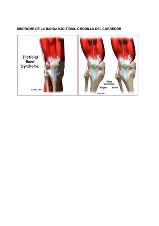 SINDROME DE LA BANDA ILIO-TIBIAL O RODILLA DEL CORREDOR
 