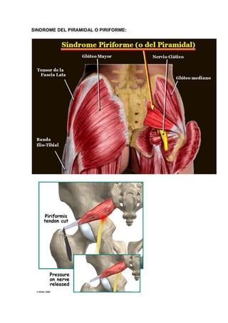 SINDROME DEL PIRAMIDAL O PIRIFORME:
 