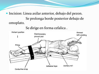  Incision: Linea axilar anterior, debajo del pezon.
              Se prolonga borde posterior debajo de
  omoplato.
              Se dirige en forma cefalica .
 