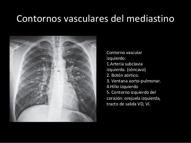 ANATOMÍA DEL TÓRAX EN TC