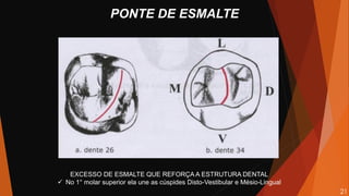 EXCESSO DE ESMALTE QUE REFORÇA A ESTRUTURA DENTAL
 No 1° molar superior ela une as cúspides Disto-Vestibular e Mésio-Lingual
PONTE DE ESMALTE
21
 