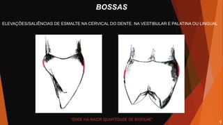 BOSSAS
ELEVAÇÕES/SALIÊNCIAS DE ESMALTE NA CERVICAL DO DENTE. NA VESTIBULAR E PALATINA OU LINGUAL
*ONDE HÁ MAIOR QUANTIDADE DE BIOFILME*
9
 