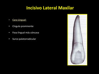 Incisivo Lateral Maxilar Cara Lingual: Cíngulo prominente Fosa lingual más cóncava Surco palatorradicular  