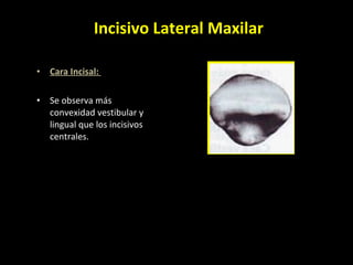 Cara Incisal:  Se observa más convexidad vestibular y lingual que los incisivos centrales.  Incisivo Lateral Maxilar 