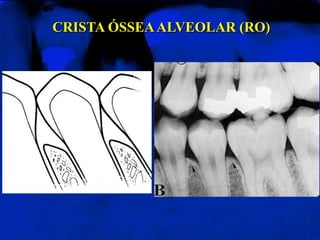 CRISTA ÓSSEAALVEOLAR (RO)
 