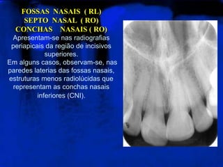 FOSSAS NASAIS ( RL)
SEPTO NASAL ( RO)
CONCHAS NASAIS ( RO)
Apresentam-se nas radiografias
periapicais da região de incisivos
superiores.
Em alguns casos, observam-se, nas
paredes laterias das fossas nasais,
estruturas menos radiolúcidas que
representam as conchas nasais
inferiores (CNI).
 