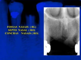 FOSSAS NASAIS ( RL)
SEPTO NASAL ( RO)
CONCHAS NASAIS ( RO)
 