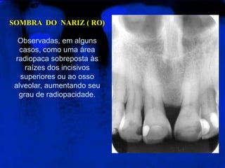 SOMBRA DO NARIZ ( RO)
Observadas, em alguns
casos, como uma área
radiopaca sobreposta às
raízes dos incisivos
superiores ou ao osso
alveolar, aumentando seu
grau de radiopacidade.
 