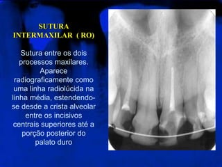 SUTURA
INTERMAXILAR ( RO)
Sutura entre os dois
processos maxilares.
Aparece
radiograficamente como
uma linha radiolúcida na
linha média, estendendo-
se desde a crista alveolar
entre os incisivos
centrais superiores até a
porção posterior do
palato duro
 