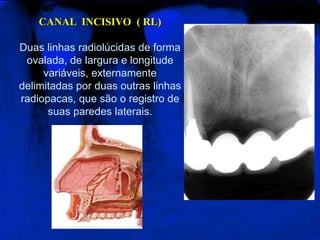 CANAL INCISIVO ( RL)
Duas linhas radiolúcidas de forma
ovalada, de largura e longitude
variáveis, externamente
delimitadas por duas outras linhas
radiopacas, que são o registro de
suas paredes laterais.
 