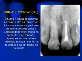 FORAME INCISIVO ( RL)
Situado à altura do rebordo
alveolar, entre as raízes dos
incisivos centrais superiores
ou acima de seus ápices.
Estes podem variar muito no
tamanho e no formato,
aparecendo como áreas
radiolúcidas ovais, em forma
de coração ou em forma de
diamante
 