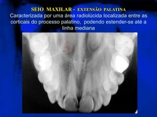 SEIO MAXILAR - EXTENSÃO PALATINA
Caracterizada por uma área radiolúcida localizada entre as
corticais do processo palatino, podendo estender-se até a
linha mediana
 