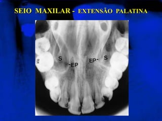SEIO MAXILAR - EXTENSÃO PALATINA
 