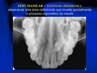 SEIO MAXILAR - EXTENSÃO ZIGOMÁTICA
observa-se uma área radiolúcida que invade parcialmente
o processo zigomático da maxila
 