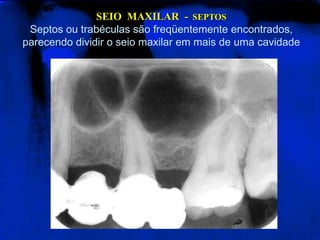 SEIO MAXILAR - SEPTOS
Septos ou trabéculas são freqüentemente encontrados,
parecendo dividir o seio maxilar em mais de uma cavidade
 