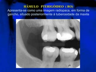 HÂMULO PTERIGÓIDEO ( RO)
Apresenta-se como uma imagem radiopaca, em forma de
gancho, situado posteriormente à tuberosidade da maxila
 