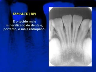 ESMALTE ( RP)
É o tecido mais
mineralizado do dente e,
portanto, o mais radiopaco.
 