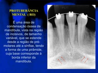 PROTUBERÂNCIA
MENTAL ( RO)
É uma área de
condensação óssea da
mandíbula, vista na região
de incisivos, de tamanho
variável, que se estende
desde a região de pré-
molares até a sínfise, tendo
a forma de uma pirâmide,
cuja base corresponde à
borda inferior da
mandíbula.
 
