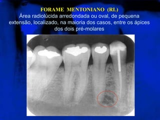FORAME MENTONIANO (RL)
Área radiolúcida arredondada ou oval, de pequena
extensão, localizado, na maioria dos casos, entre os ápices
dos dois pré-molares
 