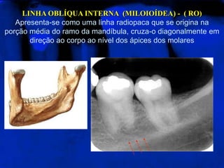 LINHA OBLÍQUA INTERNA (MILOIOÍDEA) - ( RO)
Apresenta-se como uma linha radiopaca que se origina na
porção média do ramo da mandíbula, cruza-o diagonalmente em
direção ao corpo ao nível dos ápices dos molares
 