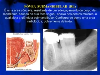FÓVEA SUBMANDIBULAR (RL)
É uma área côncava, resultante de um adelgaçamento do corpo da
mandíbula, situada na sua face lingual, abaixo dos dentes molares, a
qual aloja a glândula submandibular. Configura-se como uma área
radiolúcida, pobremente definida.
 